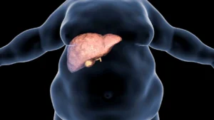 fatty-liver